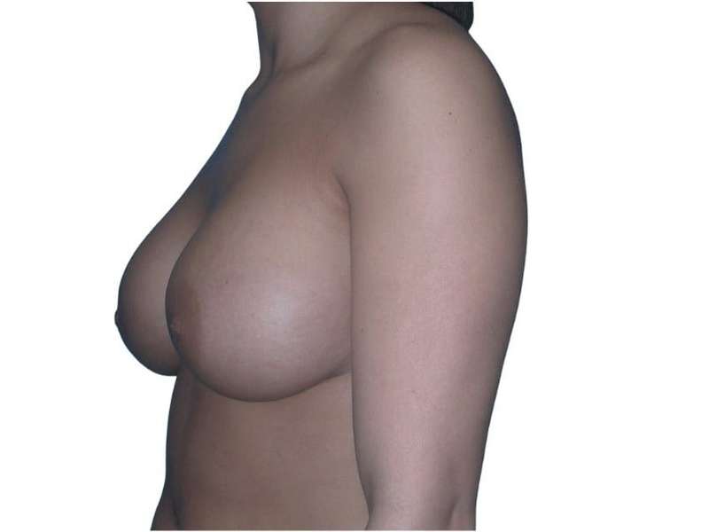 Breast Augmentation Before & After Patient #670