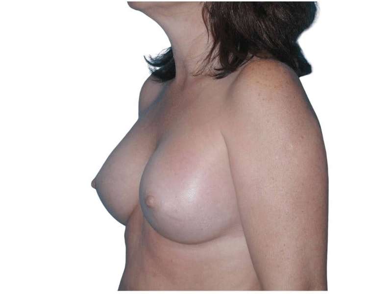 Breast Augmentation Before & After Patient #686