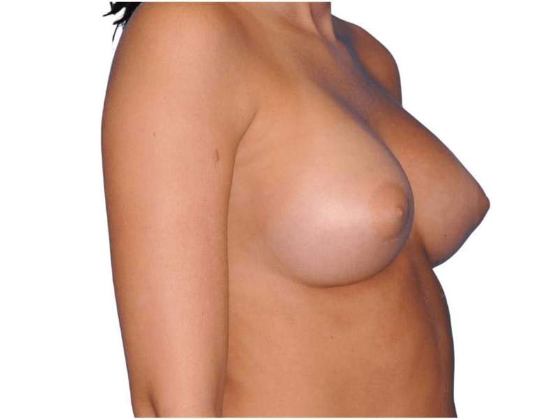 Breast Augmentation Before & After Patient #693