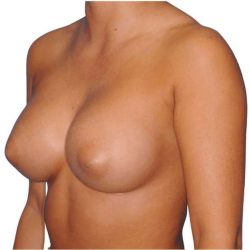 Breast Augmentation Before & After Patient #700