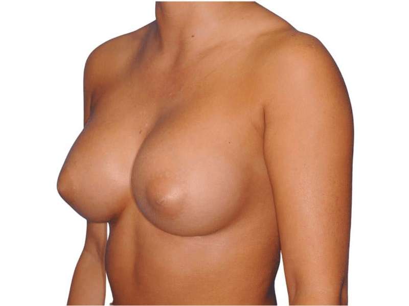 Breast Augmentation Before & After Patient #700