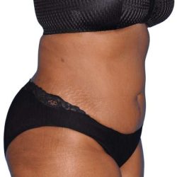 Tummy Tuck Before & After Patient #454