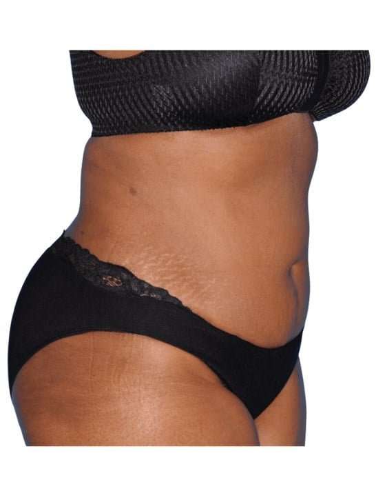 Tummy Tuck Before & After Patient #454