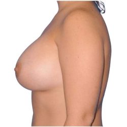 Breast Augmentation Before & After Patient #726