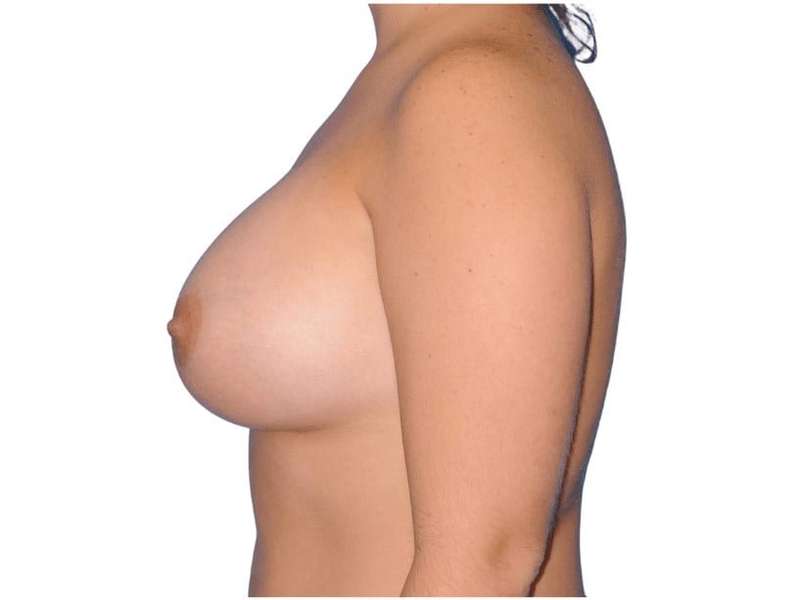 Breast Augmentation Before & After Patient #726