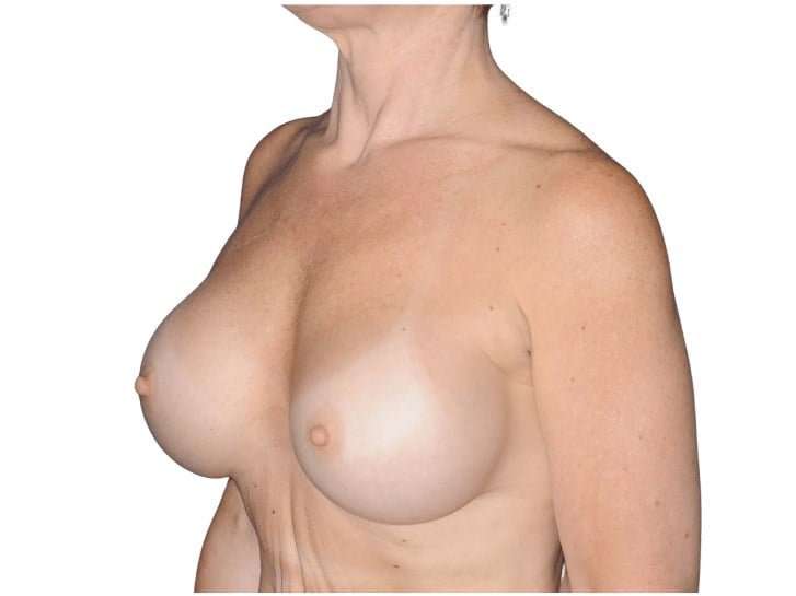 Breast Augmentation Before & After Patient #740
