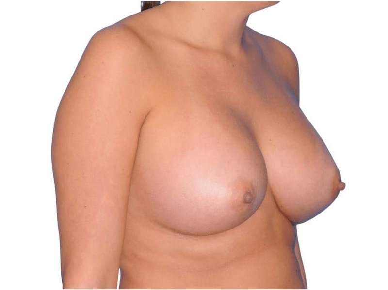 Breast Augmentation Before & After Patient #747