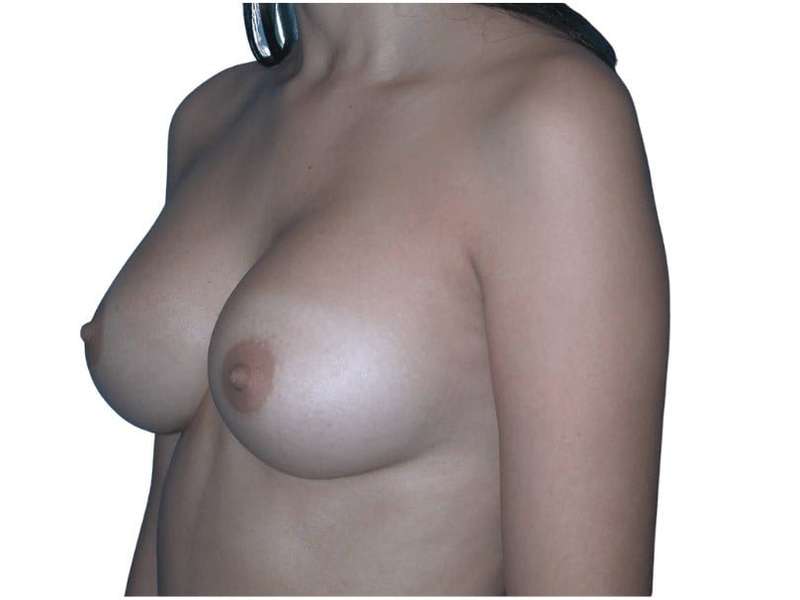 Breast Augmentation Before & After Patient #754