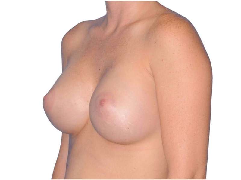 Breast Augmentation Before & After Patient #768