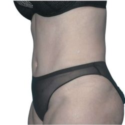 Tummy Tuck Before & After Patient #459