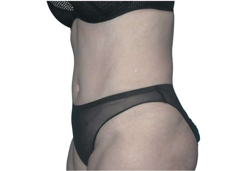 Tummy Tuck Before & After Patient #459