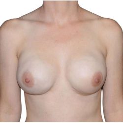 Breast Reconstruction Before & After Patient #794