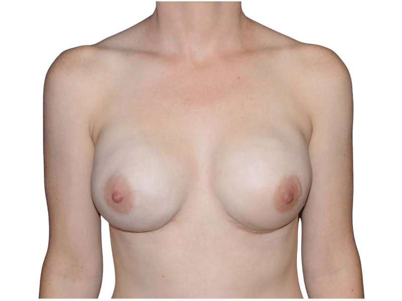Breast Reconstruction Before & After Patient #794