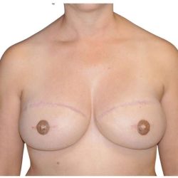 Breast Reconstruction Before & After Patient #805