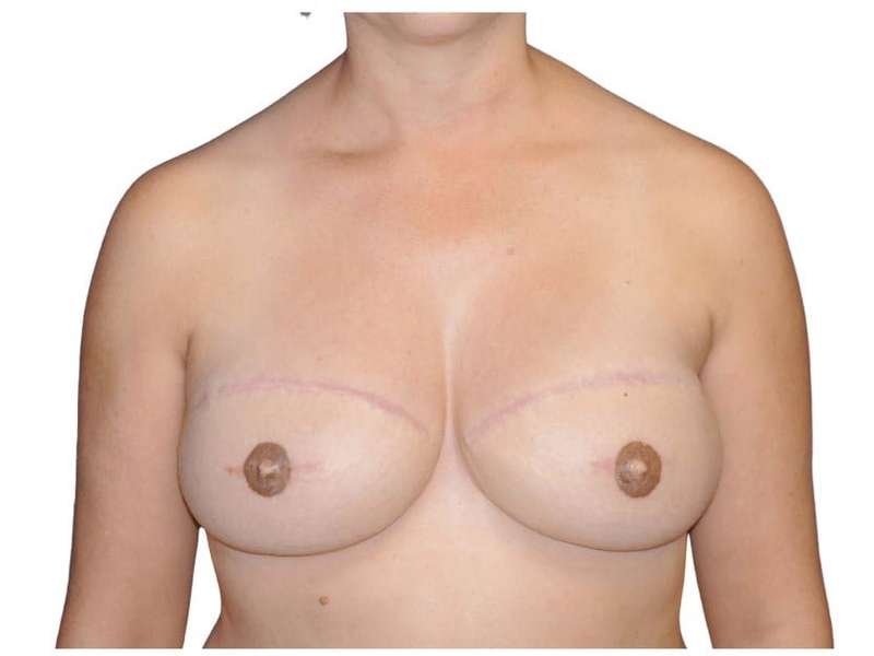 Breast Reconstruction Before & After Patient #805