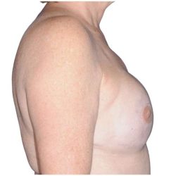 Breast Reconstruction Before & After Patient #810