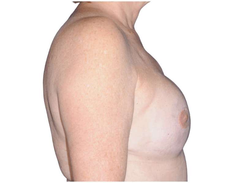 Breast Reconstruction Before & After Patient #810