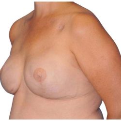Breast Reconstruction Before & After Patient #828