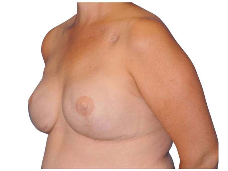 Breast Reconstruction Before & After Patient #828