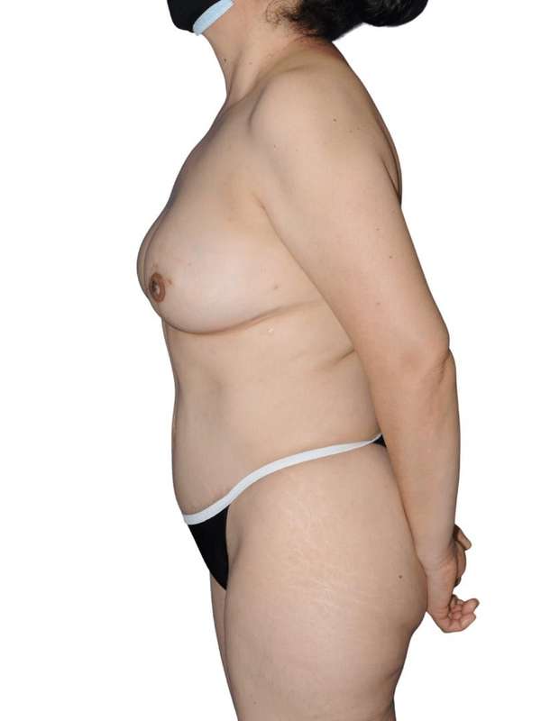 Breast Reconstruction Before & After Patient #853