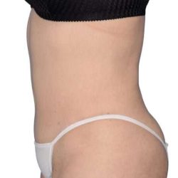 Tummy Tuck Before & After Patient #464