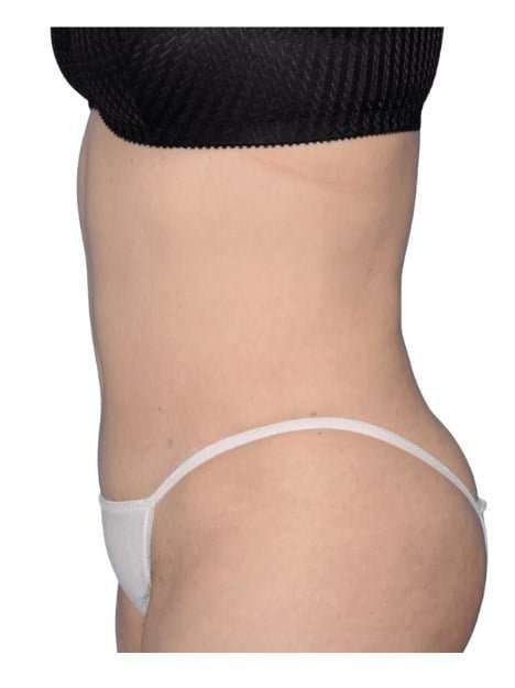Tummy Tuck Before & After Patient #464