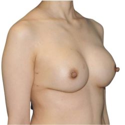 Breast Reconstruction Before & After Patient #880