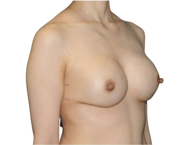 Breast Reconstruction Before & After Patient #880