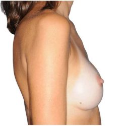 Breast Reconstruction Before & After Patient #912