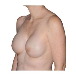 Breast Reconstruction Before & After Patient #930