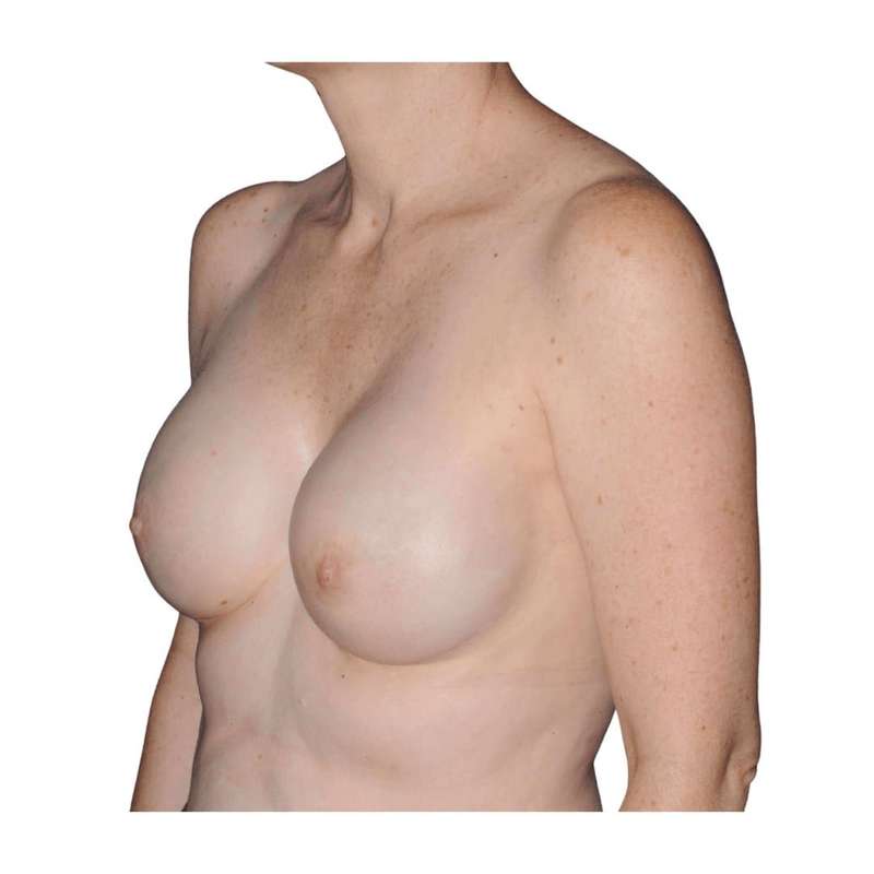 Breast Reconstruction Before & After Patient #930
