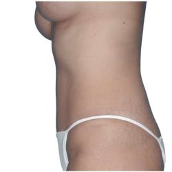 Tummy Tuck Before & After Patient #469