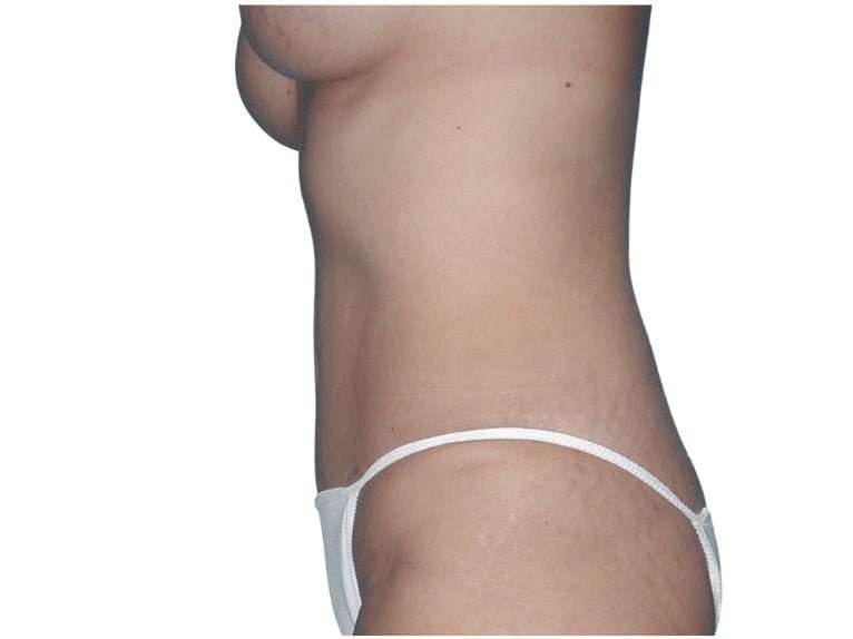 Tummy Tuck Before & After Patient #469