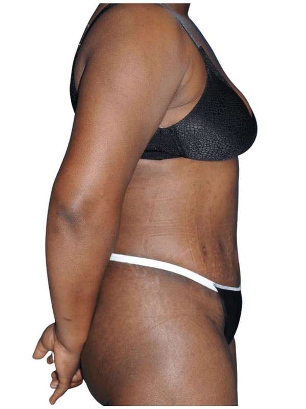 Tummy Tuck Before & After Patient #478