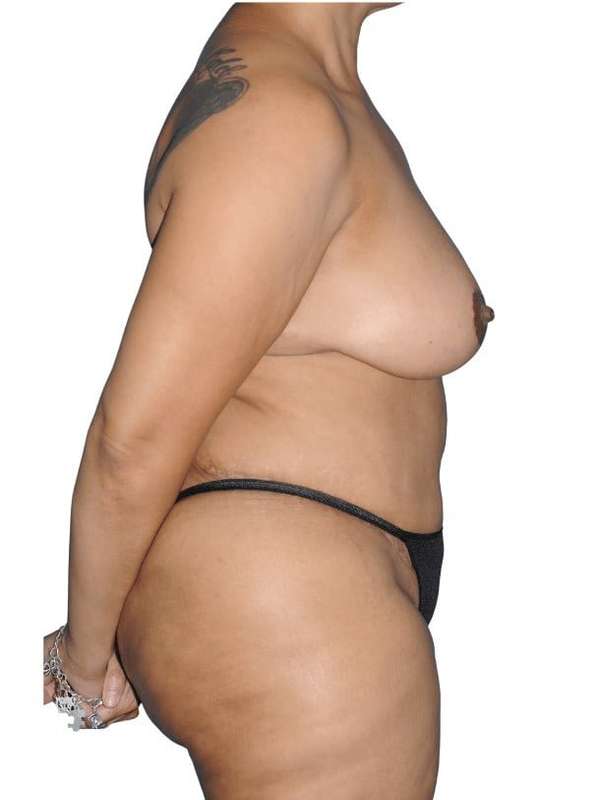 Mommy Makeover Before & After Patient #433