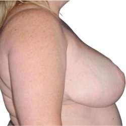 Breast Reduction Before & After Patient #579