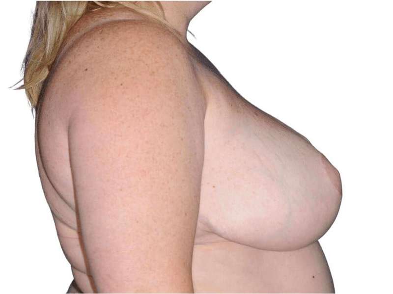 Breast Reduction Before & After Patient #579