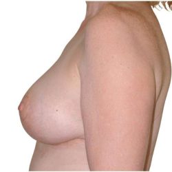 Breast Reduction Before & After Patient #586