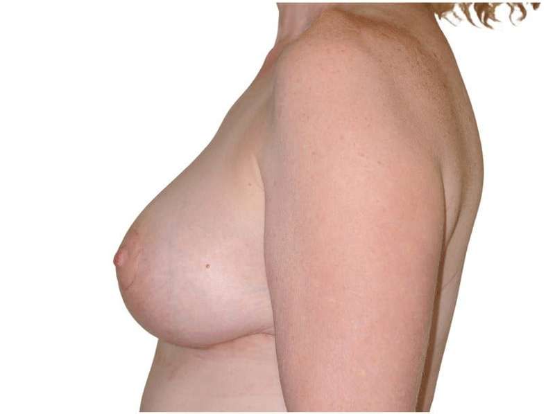 Breast Reduction Before & After Patient #586