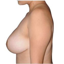 Breast Reduction Before & After Patient #593