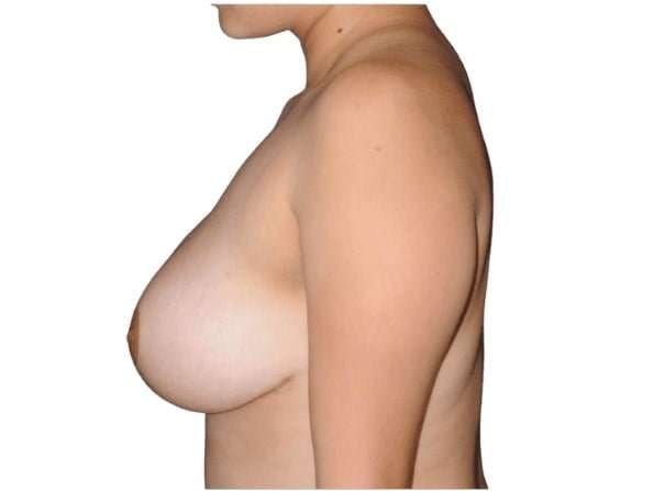 Breast Reduction Before & After Patient #593
