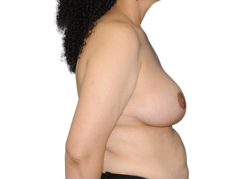 Breast Reduction Before & After Patient #601