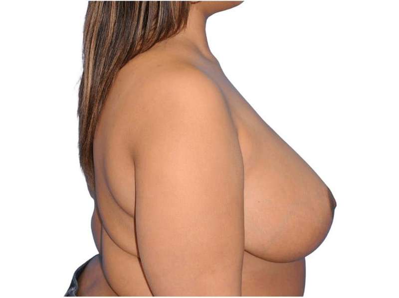 Breast Reduction Before & After Patient #617