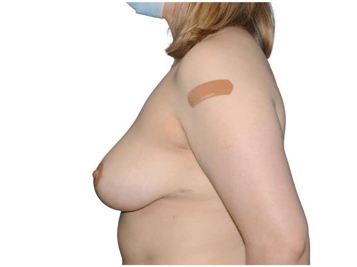 Breast Reduction Before & After Patient #624