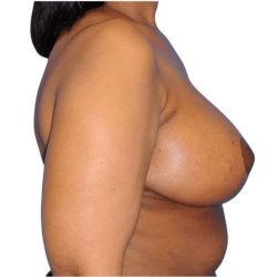 Breast Reduction Before & After Patient #642
