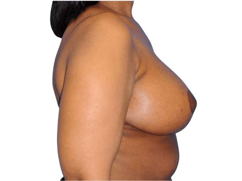 Breast Reduction Before & After Patient #642