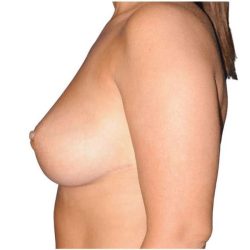 Breast Reduction Before & After Patient #649