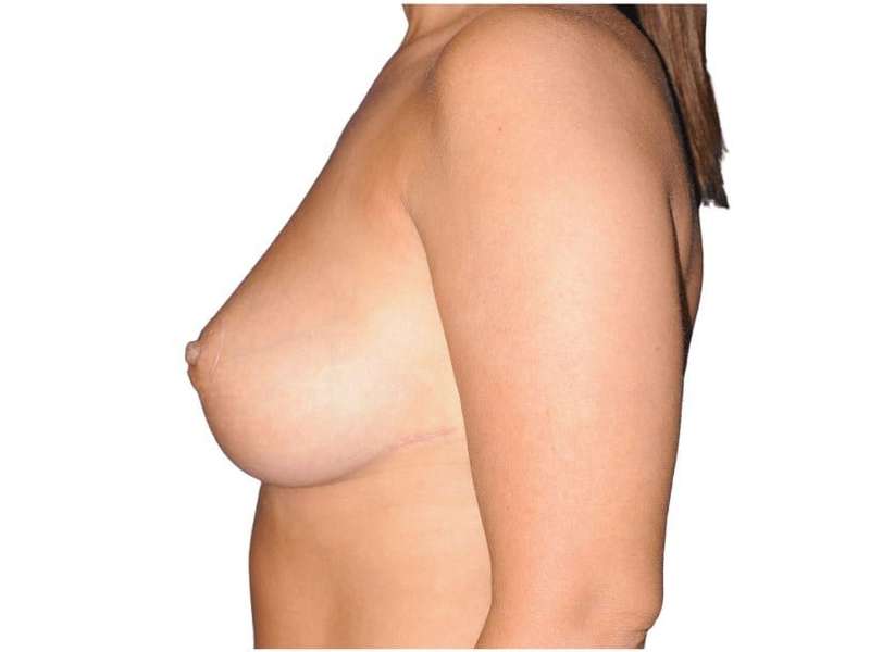 Breast Reduction Before & After Patient #649
