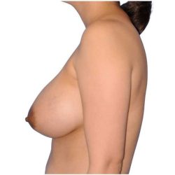 Breast Augmentation Before & After Patient #656