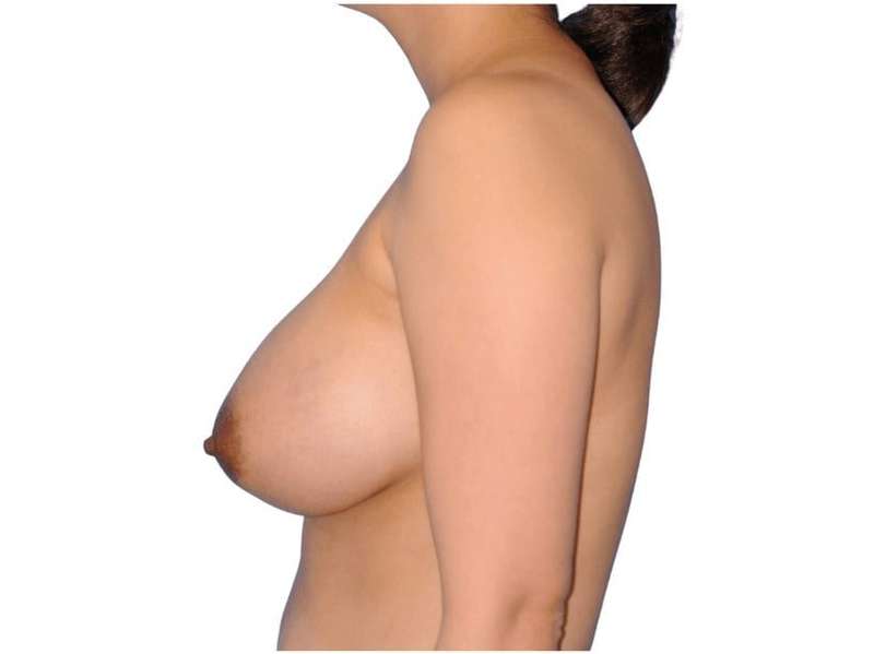 Breast Augmentation Before & After Patient #656